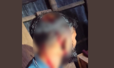 আ.লীগের হামলায় আহত বিএনপি নেতা জসিম উদ্দীন ওরফে বাকু।  ছবি- রূপালী বাংলাদেশ