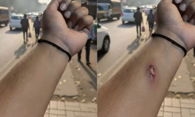 এআই দিয়ে আহত হাতের ছবি বানিয়ে অফিসকে বোকা বানালেন কর্মী