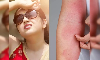 গরমে ঘামাচি ও র‍্যাশের জ্বালাপোড়া ঘরোয়া এই ৫ প্রতিকারেই মিলবে মুক্তি