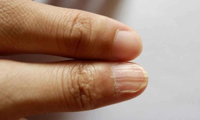 রক্তশূন্যতায় ভুগছেন কি না বুঝবেন কীভাবে