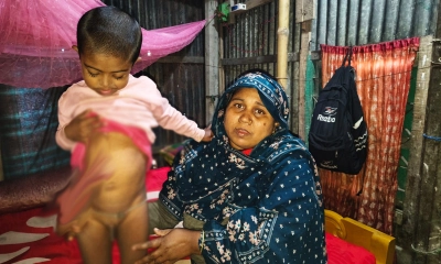 জন্ম থেকেই নেই পায়ুপথ, প্রতি নিঃশ্বাসে বাঁচার লড়াই ওমরের