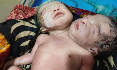 পিরোজপুরের স্বরূপকাঠিতে দুই মাথাওয়ালা শিশুর জন্ম