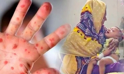 হামে আক্রান্তের সংখ্যা কবে কমবে?