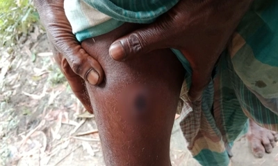 মিঠাপুকুরে অ্যানথ্রাক্স উপসর্গের রোগী বাড়ছেই। ছবি- রূপালী বাংলাদেশ