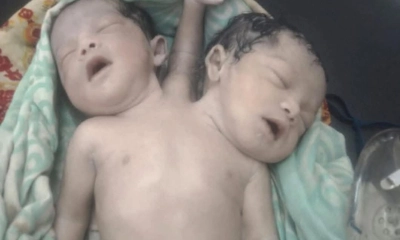 নওগাঁয় ২ মাথা ৩ হাতওয়ালা শিশুর জন্ম