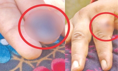বিরল রোগে আক্রান্ত  দুই শতাধিক মানুষ