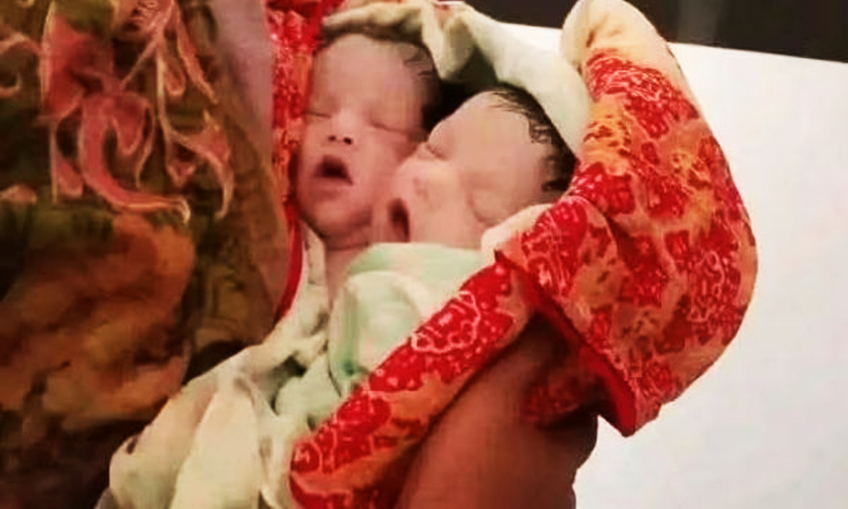 বিরল শারীরিক গঠনের নবজাতক। ছবি- রূপালী বাংলাদেশ