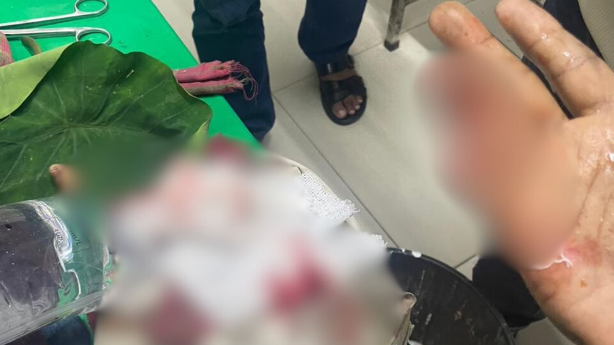 প্রভাষক মো. নূরুল ইসলাম লিটনের কেটে ফেলে আঙুল। ছবি- রূপালী বাংলাদেশ