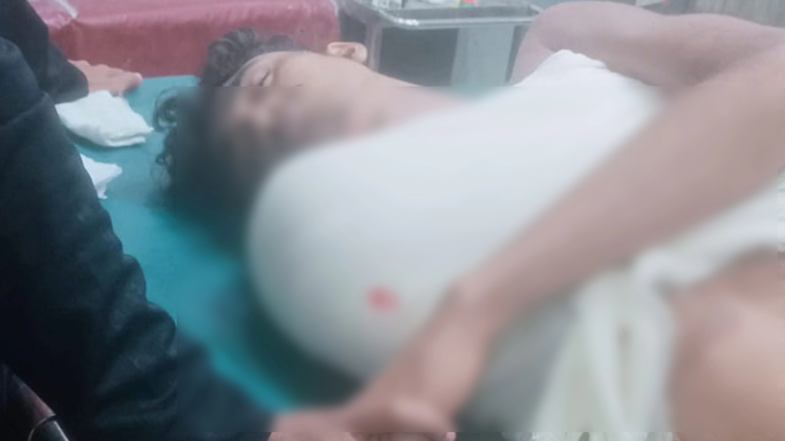 কাঁধ থেকে হাত চিচ্ছিন্ন হওয়া যুবক।