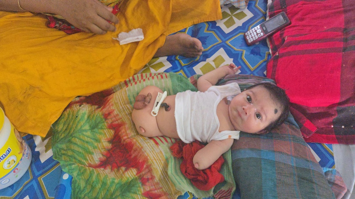 পা ও একটি হাতবিহীন জন্ম নেওয়া শিশুটি। ছবি : রূপালী বাংলাদেশ